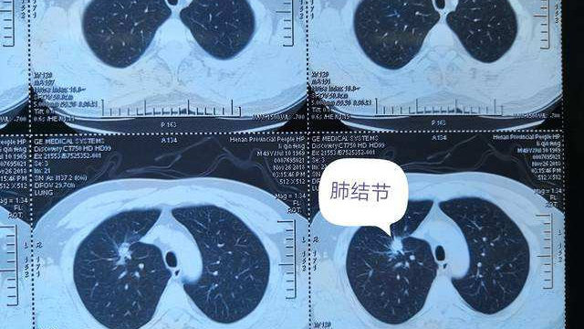 最新肺结节贴吧热议话题探讨，肺结节贴吧最新动态与探讨