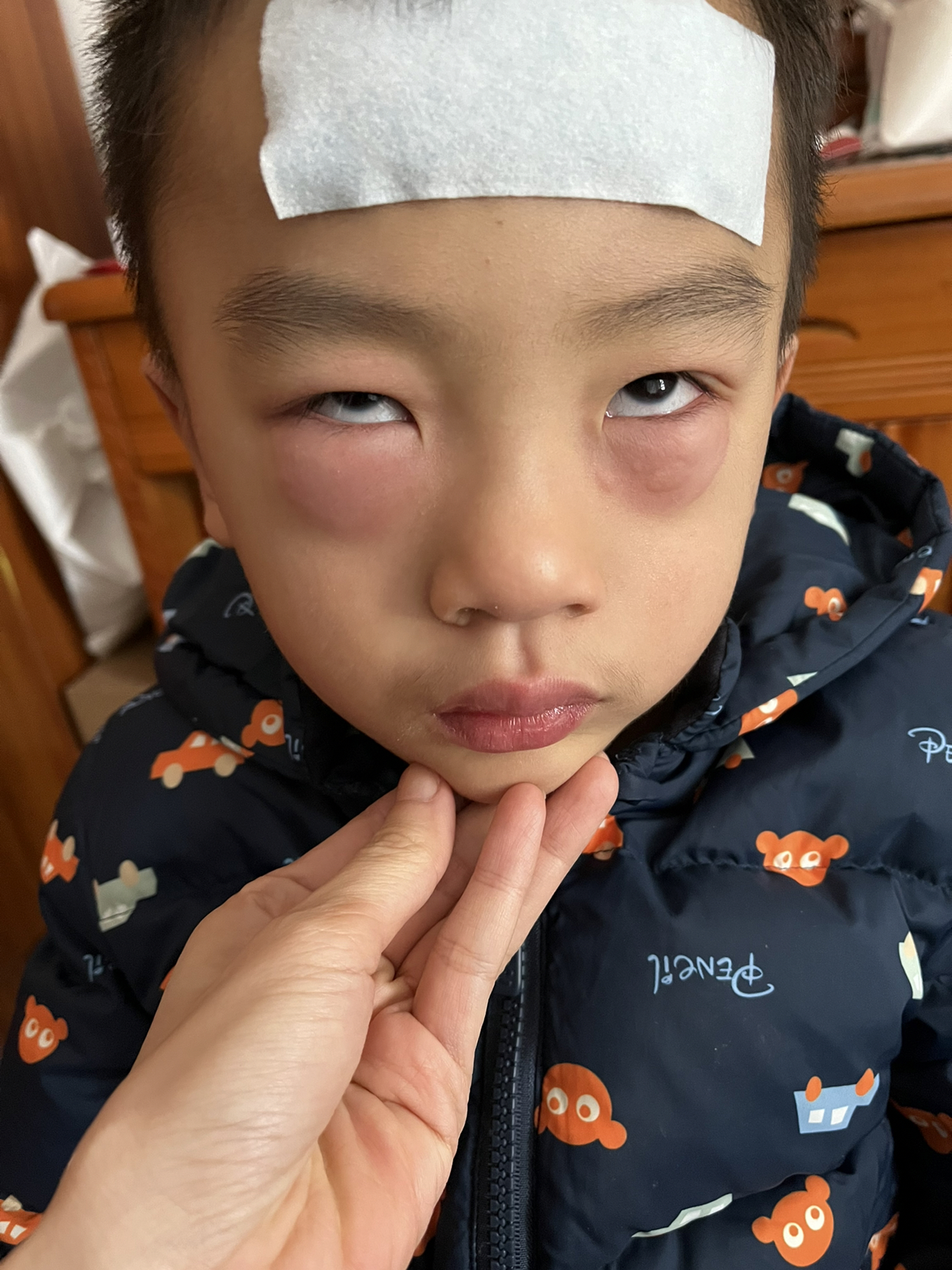 最新病毒引发眼睛肿胀症状及应对方法指南