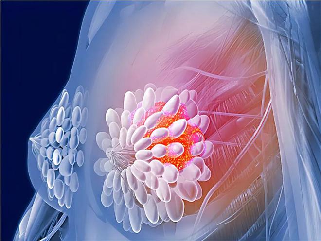 乳腺癌最新进展，科学突破照亮治疗希望之光