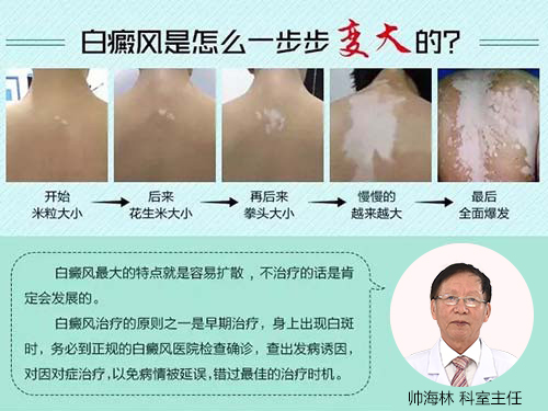 白癜风最新治疗方法深度探讨与研究