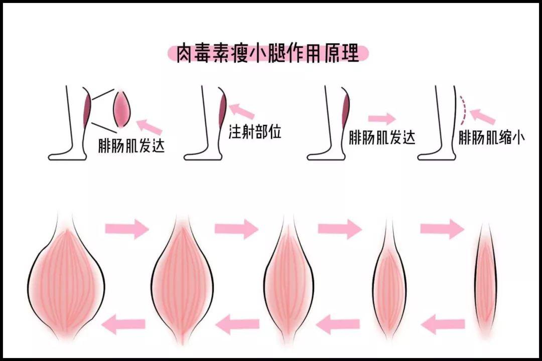 溶脂针最新技术革新与应用前景探索